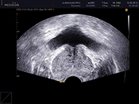 Ultrasound van de prostaat