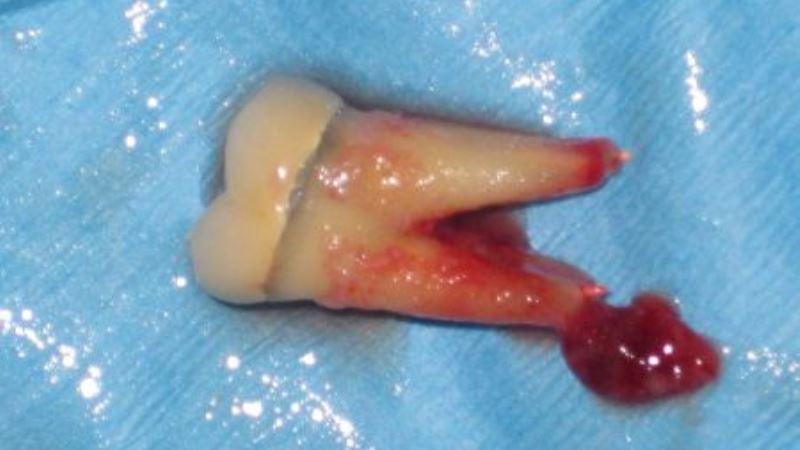 Perforation root: was es ist, Behandlung