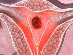 Sarcoma of the uterus