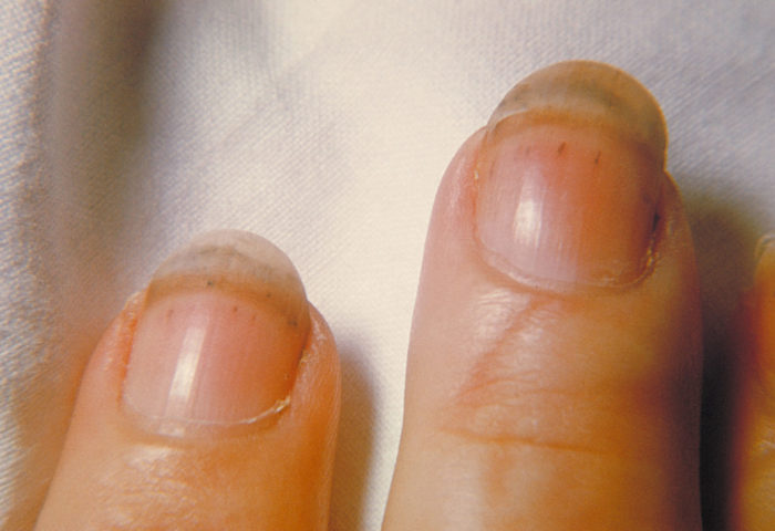 Shrapnel hemorrhages