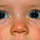 Inflamação dos olhos em recém-nascidos