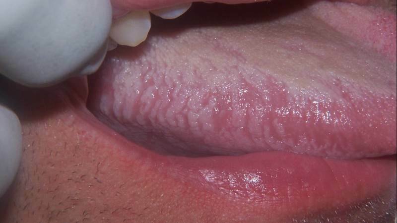 ochorení ústnej sliznice