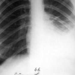 Sve o tuberkuloznoj pleuriji