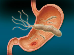Heartburn at night: reasons for what to do