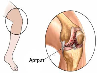 Komplikácie artritídy