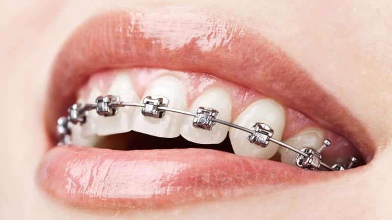 ¿Cuánto son los frenos en los dientes: adolescente precio