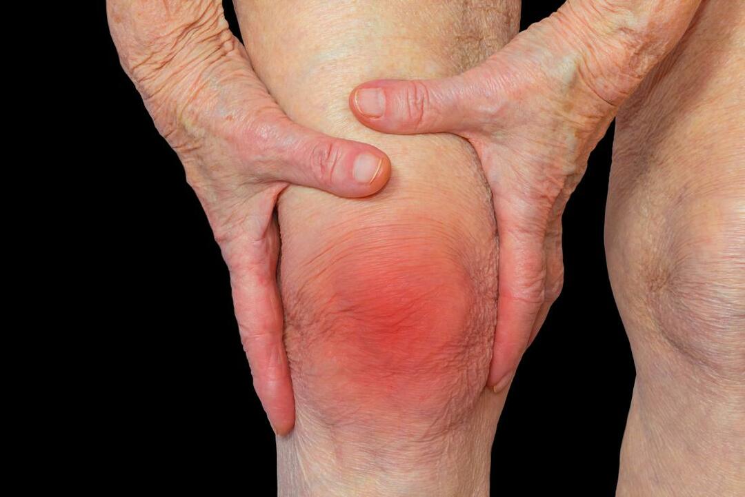 Arthritis: what is it, causes, symptoms, treatment, prognosis