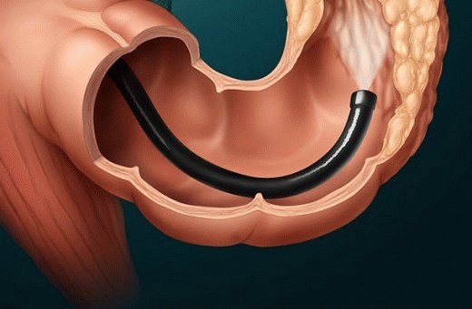 Sigmoïdoscopieprocedure