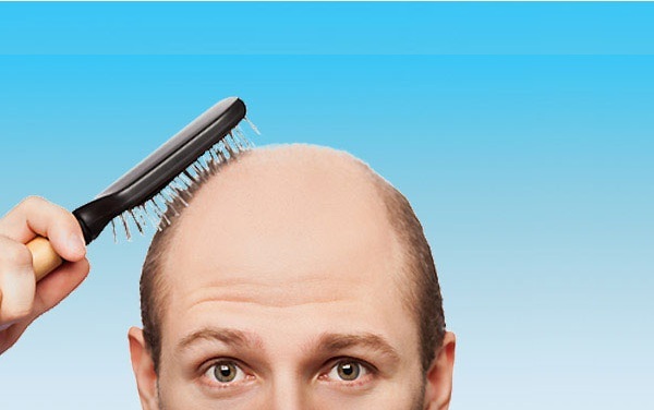 Baldness in men: well-known methods of struggle