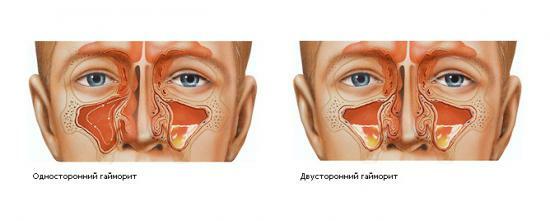 Oboustranný zánět vedlejších nosních dutin - příčiny nemoci a léčby