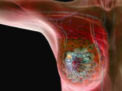 Rakovina prsu a její příznaky