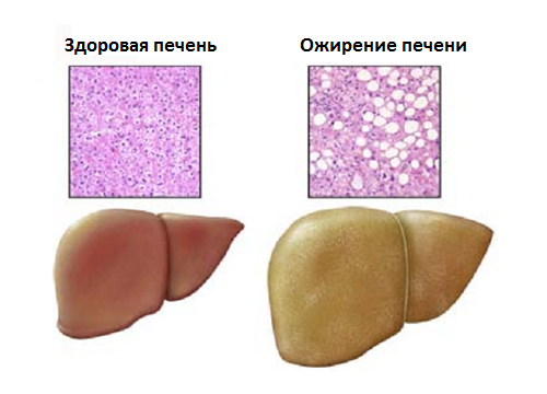Obesity-liver