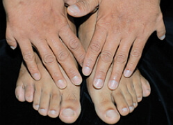 Foto polydactyly