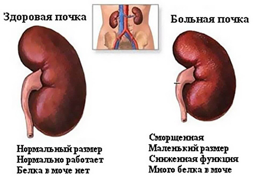 Kidney pathology.