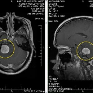 Brain Tumor-2