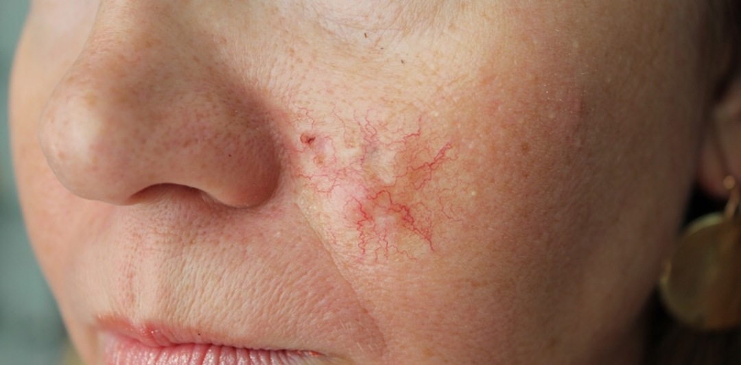 Basalioma (basal cell skin cancer): initial stage, photos, symptoms and treatment