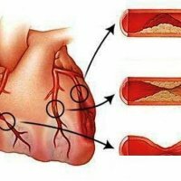 Contra-indicações para infarto do miocárdio