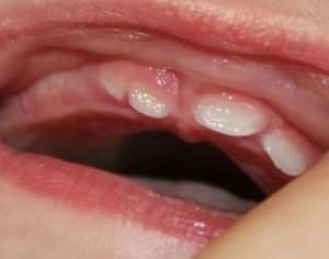 znaki zob pri dojenčkih