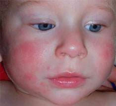 Alergija na fotografiji lica