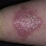 Treatment and symptoms of red lichen planus