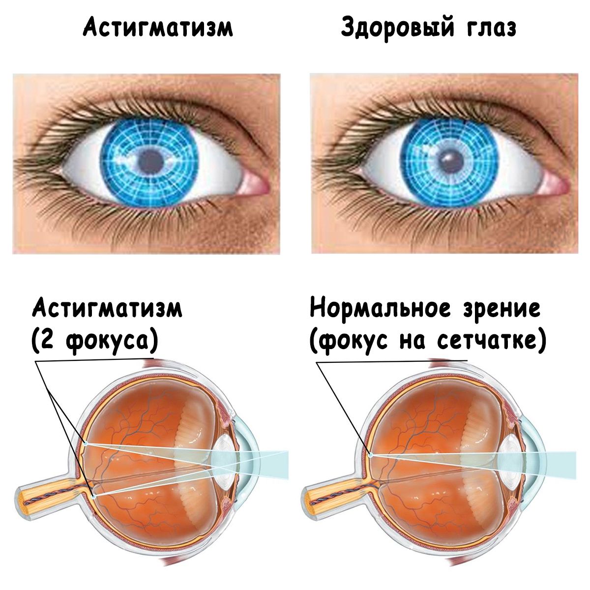Astygmatyzm dalekowzroczny: co to jest, objawy, leczenie