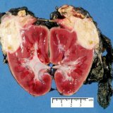 Nephroblastoma van een typische structuur