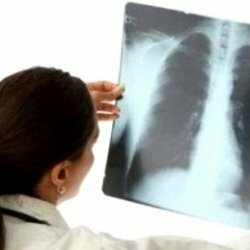 All About Prolonged Pneumonia