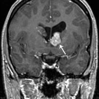 Astrocytoma( brain tumor)