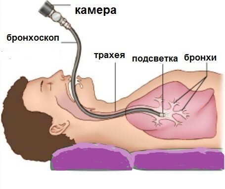 bronhoskopija