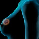 Adenocarcinoma of the breast