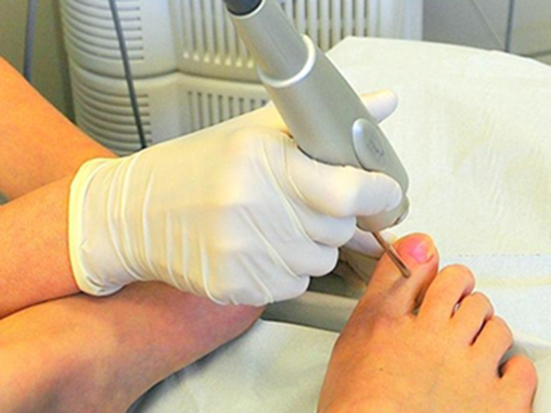 Laser treatment of nail fungus and traditional methods of treatment