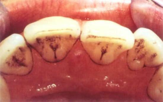 Schwarze Streifen auf den Zähnen, was ihr Aussehen verursachen können