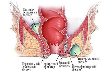 Fistula of anus.How to get rid of it