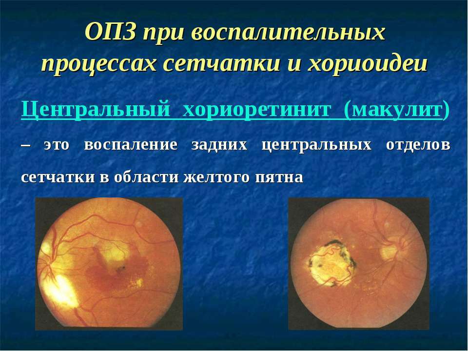 Ретинитис( упала ретине): Симптоми и лечење