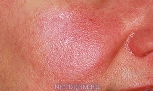 Etapa eritematosa de la rosácea en la cara