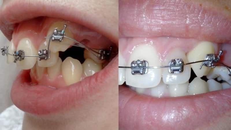 Zahnspange Fotosystem vor und nach