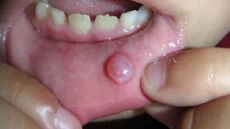 mjehurić na unutarnjoj strani usnica