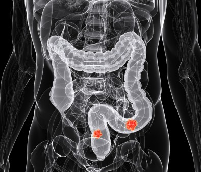 Symptoms of bowel cancer