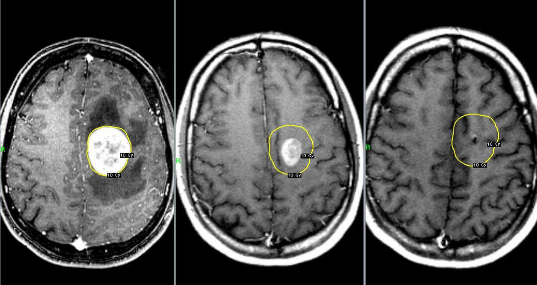 Tumor of the brain: symptoms and treatment