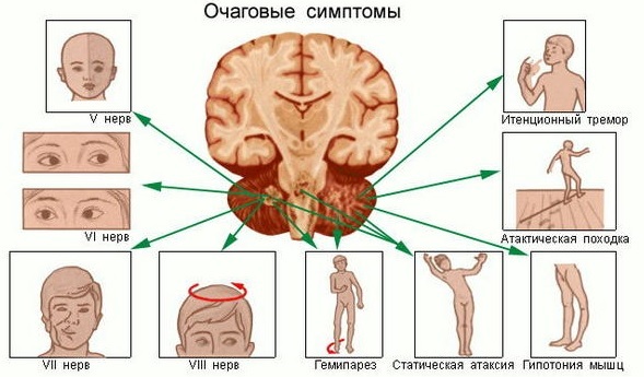 Orsaker och konsekvenser av hjärntumörer