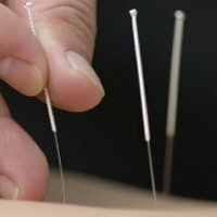 Akupunktur gegen Nierensteine