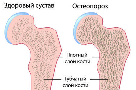 kolk osteoporoza
