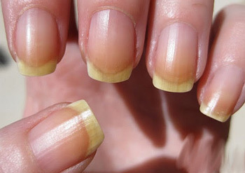 Signos y síntomas de la infección fúngica de las uñas