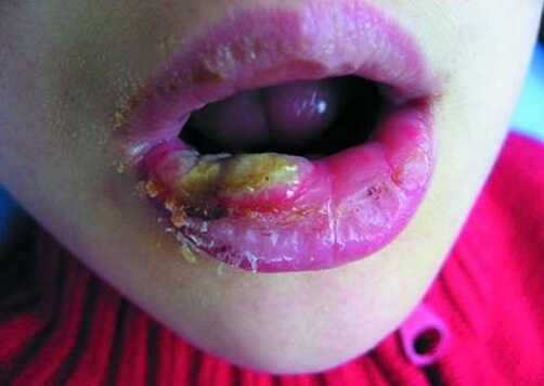 Foto van cheilitis in een kind