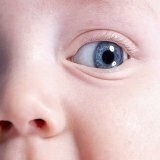 Edema of the eyes in newborns