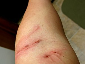 Felinose( cat scratch disease)