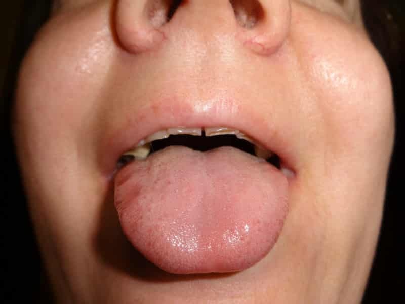 gonfiore della lingua: i motivi per cui gonfia, come evidenziato da un segno