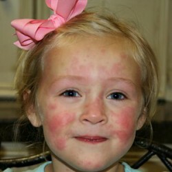 Urticaria in children photo