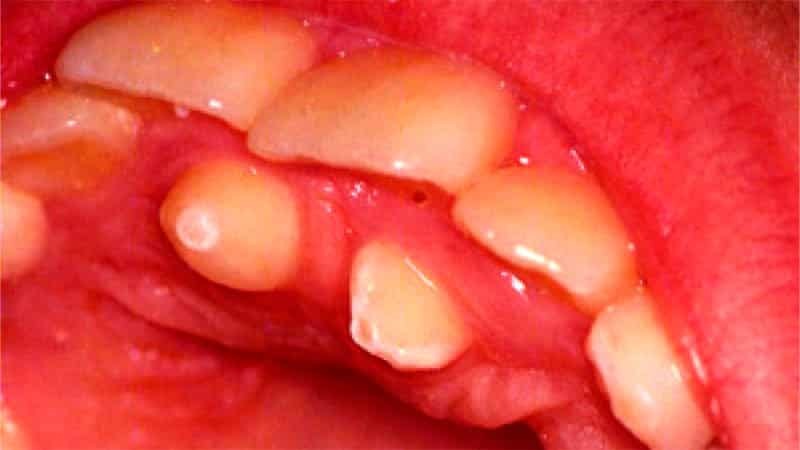 Retinished teeth
