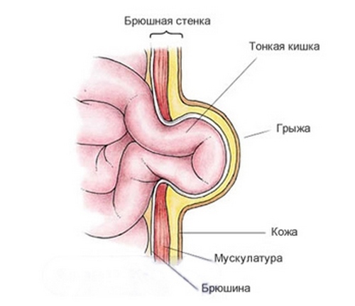 Causes and symptoms of umbilical hernia in men